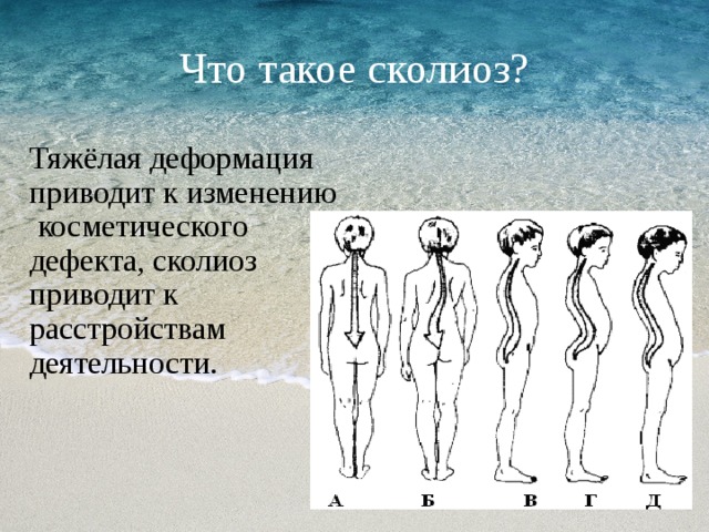 Что такое сколиоз? Тяжёлая деформация приводит к изменению косметического дефекта, сколиоз приводит к расстройствам деятельности. 
