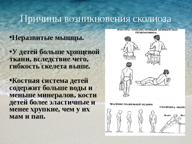 Причины возникновения сколиоза Неразвитые мышцы.  У детей больше хрящевой ткани, вследствие чего, гибкость скелета выше.  Костная система детей содержит больше воды и меньше минералов, кости детей более эластичные и менее хрупкие, чем у их мам и пап. 