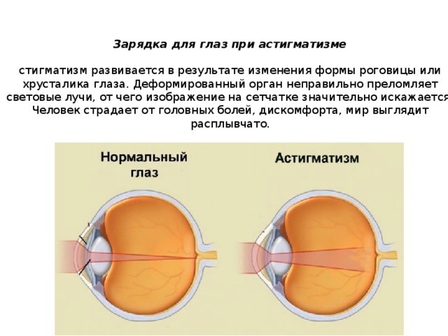 Зарядка для глаз при астигматизме   стигматизм развивается в результате изменения формы роговицы или хрусталика глаза. Деформированный орган неправильно преломляет световые лучи, от чего изображение на сетчатке значительно искажается. Человек страдает от головных болей, дискомфорта, мир выглядит расплывчато.   