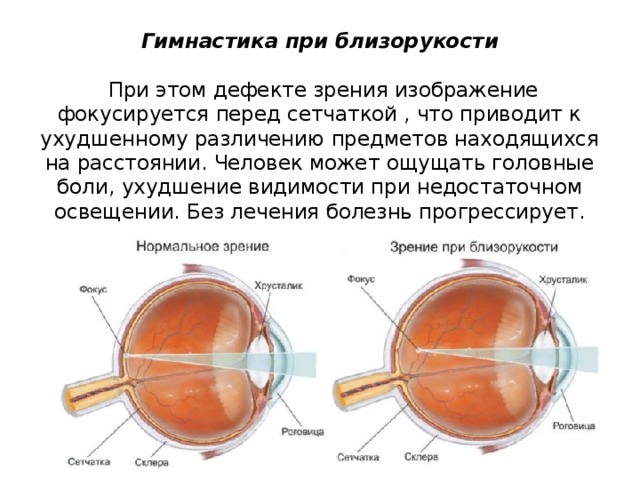 Гимнастика при близорукости    При этом дефекте зрения изображение фокусируется перед сетчаткой , что приводит к ухудшенному различению предметов находящихся на расстоянии. Человек может ощущать головные боли, ухудшение видимости при недостаточном освещении. Без лечения болезнь прогрессирует.   