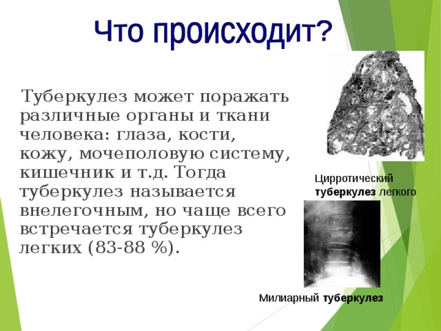  Туберкулез может поражать различные органы и ткани человека: глаза, кости, кожу, мочеполовую систему, кишечник и т.д. Тогда туберкулез называется внелегочным, но чаще всего встречается туберкулез легких (83-88 %). Цирротический туберкулез легкого Милиарный туберкулез  