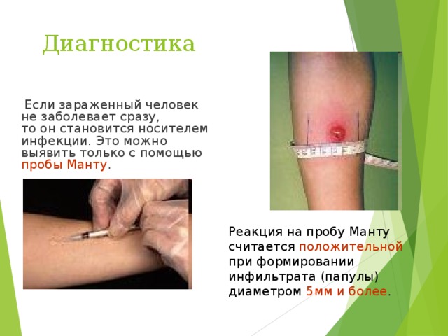 Диагностика  Если зараженный человек не заболевает сразу, то он становится носителем инфекции. Это можно выявить только с помощью пробы Манту . Реакция на пробу Манту считается положительной при формировании инфильтрата (папулы) диаметром 5мм и более . 