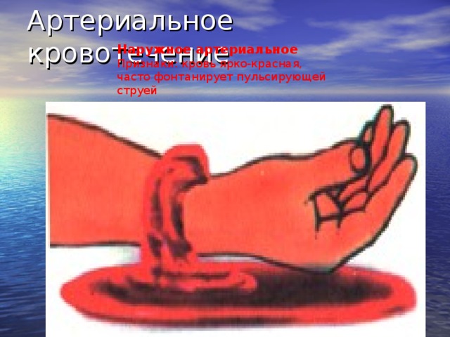 Артериальное кровотечение Наружное артериальное Признаки: кровь ярко-красная, часто фонтанирует пульсирующей струей Наиболее опасно артериальное кровотечение. Оно возникает при повреждении артериального сосуда, изливающаяся при этом кровь ярко-красного цвета и выбивается из раны сильной пульсирующей струей (иногда фонтаном).  