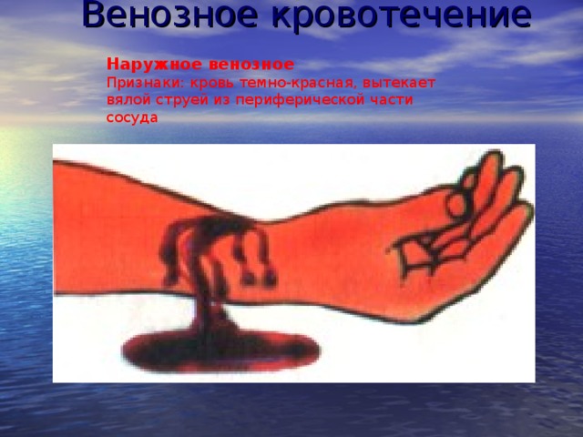  Венозное кровотечение Наружное венозное Признаки: кровь темно-красная, вытекает вялой струей из периферической части сосуда При венозном кровотечении кровь темно-красная, течет медленно, непрерывно. Венозное кровотечение менее интенсивное, чем артериальное, и поэтому реже носит угрожающий характер. Однако, при ранении вен шеи и грудной клетки имеется другая (нередко смертельная) опасность: вследствие отрицательного давления в этих венах в них в момент вдоха поступает воздух; воздушный пузырь (эмбол) может вызвать закупорку просвета кровеносного сосуда- воздушную эмболию и стать причиной молниеносной смерти.  