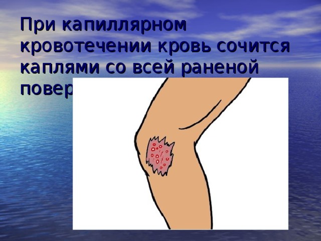 При капиллярном кровотечении кровь сочится каплями со всей раненой поверхности 