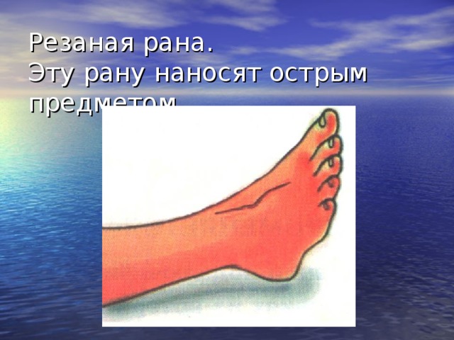 Резаная рана.  Эту рану наносят острым предметом. Резаные раны наносят острым предметом. Они характеризуются набольшим количеством разрушенных клеток; окружающие ткани не повреждаются. Зияние раны позволяет произвести осмотр поврежденных органов и создает хорошие условия для оттока отделяемого. При резаной ране имеются наиболее благоприятные условия для заживления, поэтому, обрабатывая любые свежие раны, их стремятся превратить в резаные.  