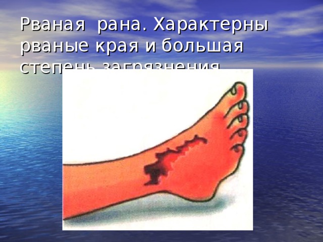 Рваная рана. Характерны рваные края и большая степень загрязнения. рваные раны являются следствием воздействия тупого предмета. Они характеризуются большим количеством размятых, ушибленных, пропитанных кровью тканей с нарушением их жизнеспособности.  