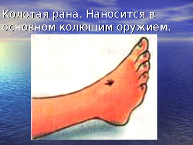 Колотая рана. Наносится в основном колющим оружием. Колотые раны наносят колющим оружием (штык, игла и др.). Анатомической особенностью их является значительная глубина при небольшом повреждении покровов. При этих ранах всегда имеется опасность повреждения жизненно важных структур, расположенных в глубине тканей, в полостях (сосуды, нервы, полые и паренхиматозные органы). Колотые раны опасны тем, что из-за бедности симптомов могут быть просмотрены повреждения глубоколежащих тканей и органов, поэтому необходимо особо тщательное обследование больного. Опасны колотые раны также тем, что с ранящим оружием в глубину тканей вносятся микроорганизмы, а раневое отделяемое, не находя выхода наружу, служит для них хорошей питательной средой, что создает особо благоприятные условия для развития гнойных осложнений.  