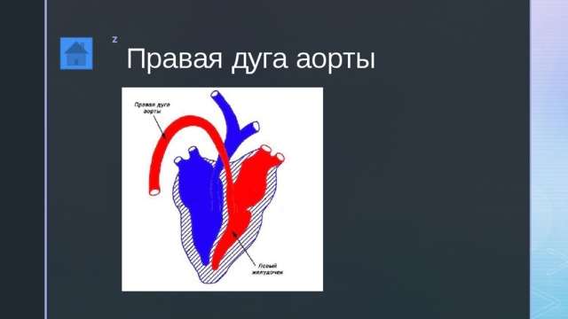 Правая дуга аорты 