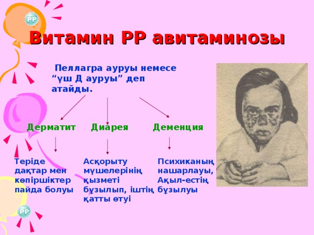 Витамин РР авитаминозы  Пеллагра ауруы немесе “үш Д ауруы” деп атайды. Диарея Деменция Дерматит Теріде дақтар мен көпіршіктер пайда болуы Асқорыту мүшелерінің қызметі бұзылып, іштің қатты өтуі Психиканың нашарлауы,Ақыл-естің бұзылуы 