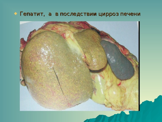 Гепатит, а в последствии цирроз печени 