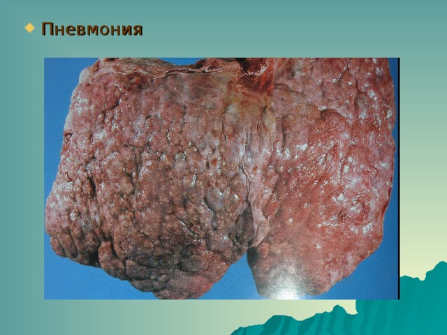 Пневмония 