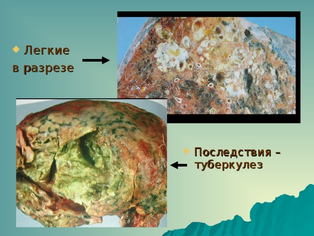 Легкие в разрезе Последствия – туберкулез 