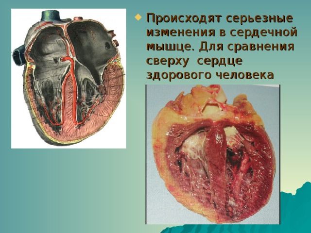 Происходят серьезные изменения в сердечной мышце. Для сравнения сверху сердце здорового человека 