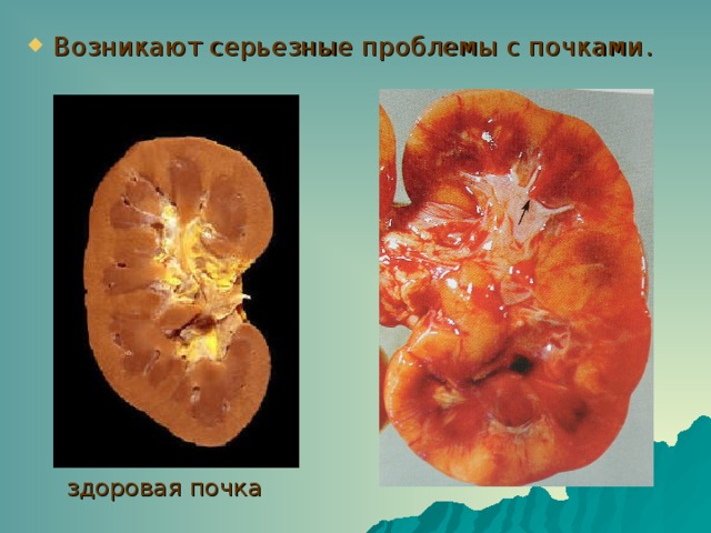 Возникают серьезные проблемы с почками . здоровая почка 