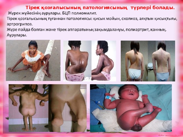 Тірек қозғалысының патологиясының түрлері болады. 