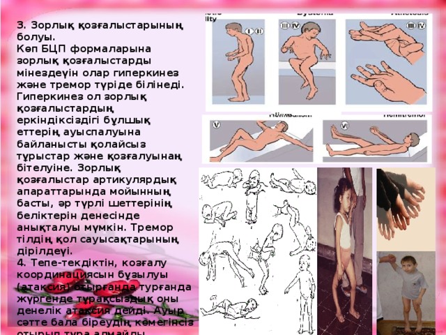 3. Зорлық қозғалыстарының болуы. Көп БЦП формаларына зорлық қозғалыстарды мінездеүін олар гиперкинез және тремор түріде білінеді. Гиперкинез ол зорлық қозғалыстардың еркіндіксіздігі бұлшық еттерің ауыспалуына байланысты қолайсыз тұрыстар және қозғалуынаң бітелуіне. Зорлық қозғалыстар артикулярдық апараттарында мойынның басты, әр түрлі шеттерінің беліктерін денесінде анықталуы мүмкін. Тремор тілдің қол сауысақтарының дірілдеүі. 4. Тепе-текдіктін, козғалу координациясын бұзылуы (атаксия) отырғанда турғанда жүргенде тұрақсыздық оны денелік атаксия дейді. Ауыр сәтте бала біреудің көмегінсіз отырып тұра алмайды. Тұрақсыз жүрісте бала аяқтарын арасын кең ашып жүреді, теңселіп баска жаққа ауа береді. Манипуляциялық әрекетте бала жазған уақытта, бірдеңені ұстаймын дегенінде қиыншылық көреді 