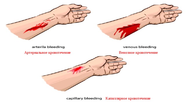 Артериальное кровотечение Венозное кровотечение Капиллярное кровотечение 