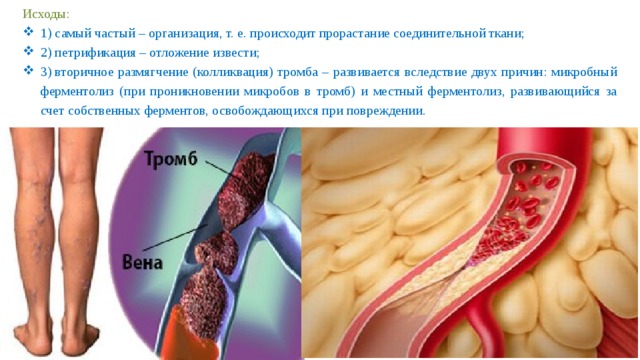 Исходы: 1) самый частый – организация, т. е. происходит прорастание соединительной ткани; 2) петрификация – отложение извести; 3) вторичное размягчение (колликвация) тромба – развивается вследствие двух причин: микробный ферментолиз (при проникновении микробов в тромб) и местный ферментолиз, развивающийся за счет собственных ферментов, освобождающихся при повреждении. 
