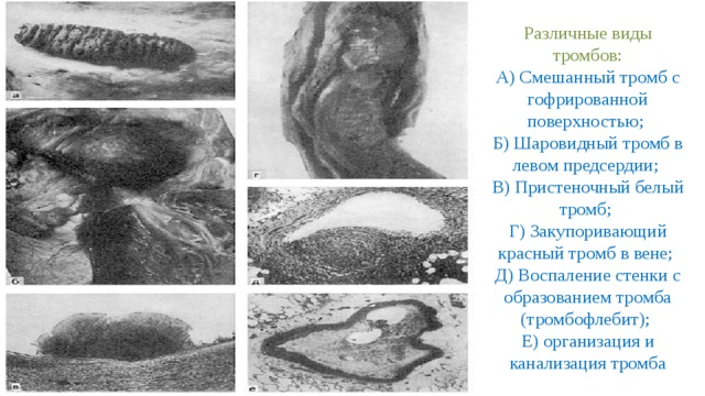 Различные виды тромбов: А) Смешанный тромб с гофрированной поверхностью; Б) Шаровидный тромб в левом предсердии; В) Пристеночный белый тромб; Г) Закупоривающий красный тромб в вене; Д) Воспаление стенки с образованием тромба (тромбофлебит); Е) организация и канализация тромба 