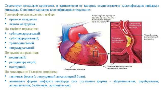 Существует несколько критериев, в зависимости от которых осуществляется классификация инфаркта миокарда. Основные варианты классификации следующие: Топографически выделяют инфаркт: правого желудочка; левого желудочка. По глубине поражения: субэндокардиальный; субэпикардиальный; трансмунальный; интрамуральный. По кратности развития: первичный; рецидивирующий; повторный. По локализации болевого синдрома: типичная форма (с загрудинной локализацией боли); атипичные формы инфаркта миокарда (все остальные формы – абдоминальная, церебральная, астматическая, безболевая, аритмическая). 