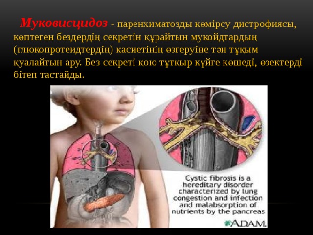  Муковисцидоз  - паренхиматозды көмірсу дистрофиясы, көптеген бездердің секретін құрайтын мукойдтардың (глюкопротеидтердің) қасиетінің өзгеруіне тән тұқым қуалайтын ару. Без секреті қою тұтқыр күйге көшеді, өзектерді бітеп тастайды. 