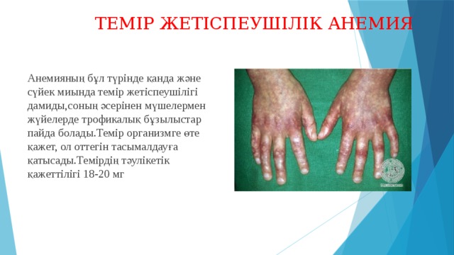  ТЕМІР ЖЕТІСПЕУШІЛІК АНЕМИЯ Анемияның бұл түрінде қанда және сүйек миында темір жетіспеушілігі дамиды,соның әсерінен мүшелермен жүйелерде трофикалық бұзылыстар пайда болады.Темір организмге өте қажет, ол оттегін тасымалдауға қатысады.Темірдің тәулікетік қажеттілігі 18-20 мг 