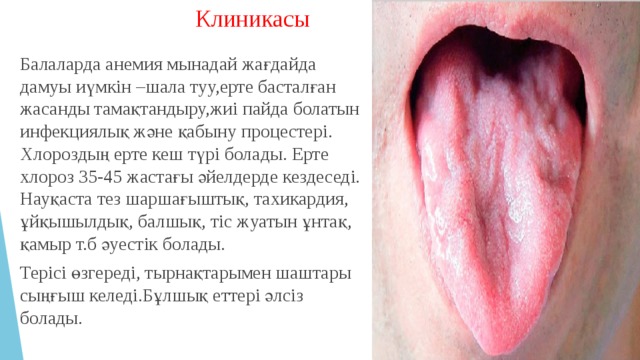 Клиникасы Балаларда анемия мынадай жағдайда дамуы иүмкін –шала туу,ерте басталған жасанды тамақтандыру,жиі пайда болатын инфекциялық және қабыну процестері. Хлороздың ерте кеш түрі болады. Ерте хлороз 35-45 жастағы әйелдерде кездеседі. Науқаста тез шаршағыштық, тахикардия, ұйқышылдық, балшық, тіс жуатын ұнтақ, қамыр т.б әуестік болады. Терісі өзгереді, тырнақтарымен шаштары сыңғыш келеді.Бұлшық еттері әлсіз болады. 