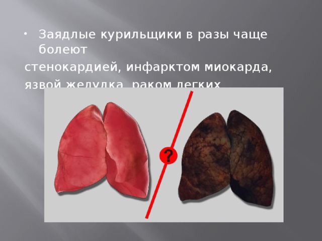 Заядлые курильщики в разы чаще болеют стенокардией, инфарктом миокарда, язвой желудка, раком легких 