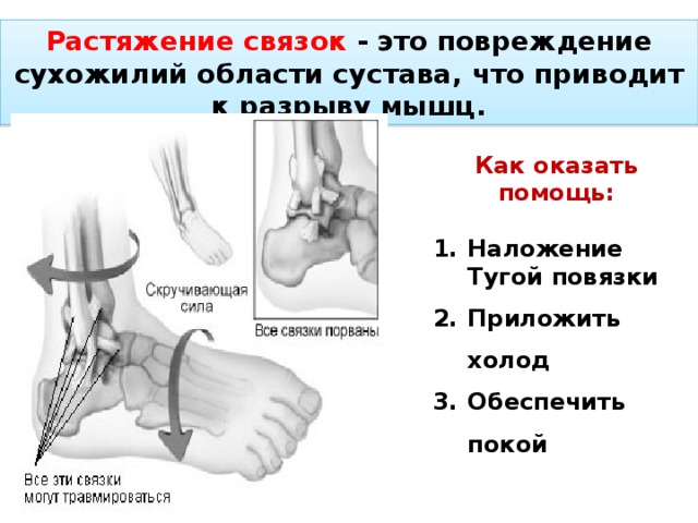 Растяжение связок - это повреждение сухожилий области сустава, что приводит к разрыву мышц. Как оказать помощь:  Наложение Тугой повязки Приложить холод Обеспечить покой 