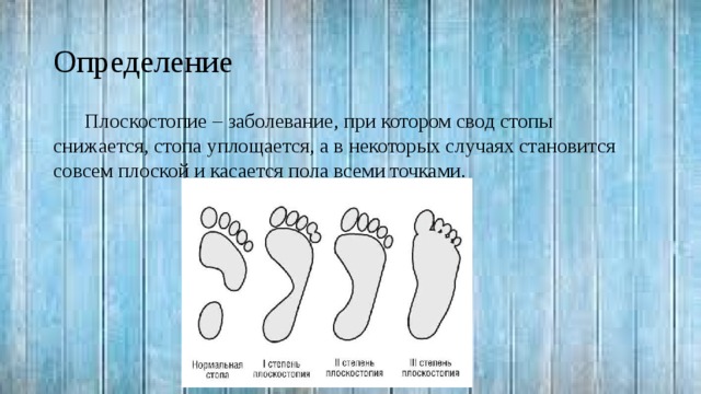 Определение Плоскостопие – заболевание, при котором свод стопы снижается, стопа уплощается, а в некоторых случаях становится совсем плоской и касается пола всеми точками. 