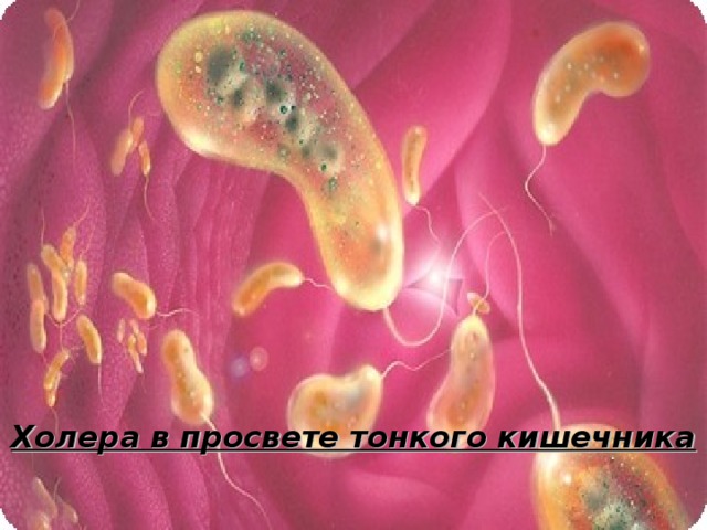 Холера в просвете тонкого кишечника 