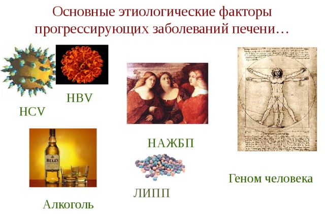 Основные этиологические факторы прогрессирующих заболеваний печени… HВV HCV НАЖБП Геном человека ЛИПП Алкоголь 