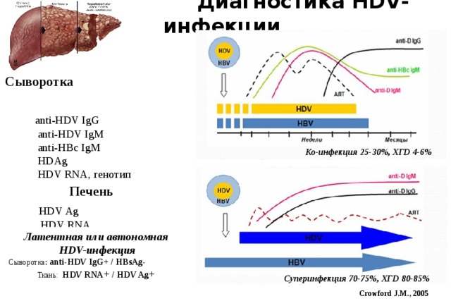  Диагностика HDV-инфекции   Сыворотка   anti-HDV IgG  anti-HDV IgM  anti-HBc IgM  HDAg  HDV RNA, генотип Печень   HDV Ag  HDV RNA Ко-инфекция 25-30%, ХГD 4-6% Латентная или автономная  HDV-инфекция Сыворотка : anti-HDV IgG+ / HBsAg- Ткань: HDV RNA + / HDV Ag +  Суперинфекция 70-75%, ХГD 80-85% Crowford J.M., 2005  
