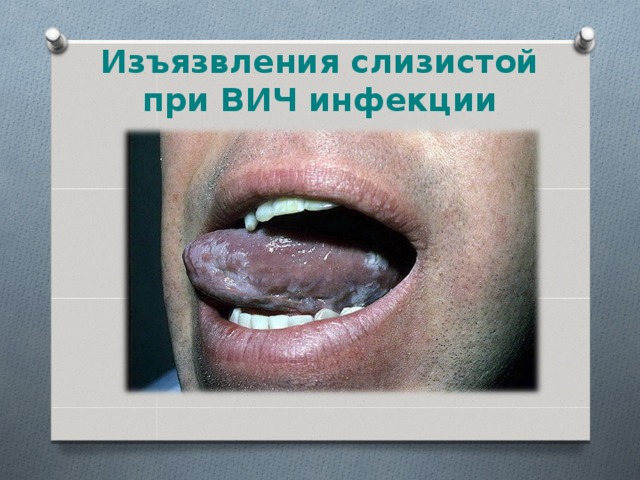 Изъязвления слизистой при ВИЧ инфекции 
