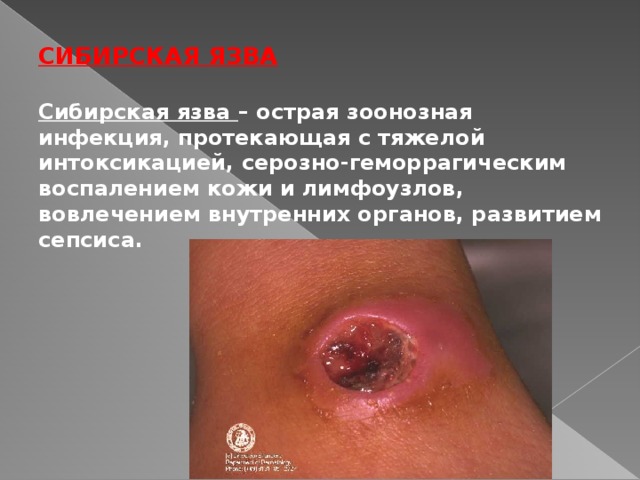СИБИРСКАЯ ЯЗВА Сибирская язва – острая зоонозная инфекция, протекающая с тяжелой интоксикацией, серозно-геморрагическим воспалением кожи и лимфоузлов, вовлечением внутренних органов, развитием сепсиса.  