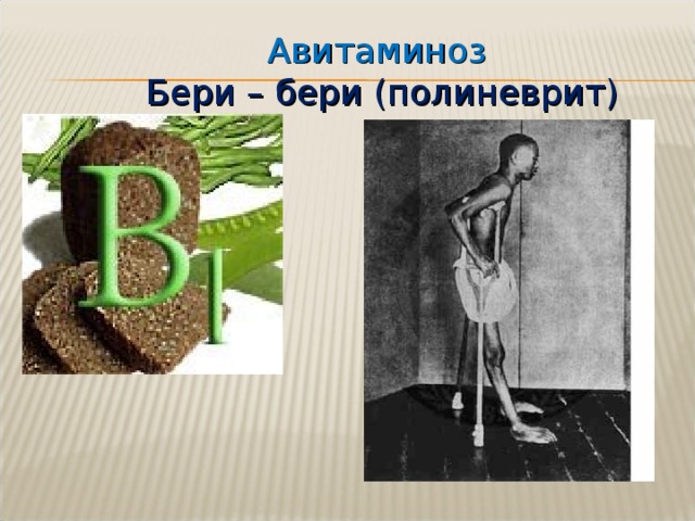 Авитаминоз Бери – бери (полиневрит) 
