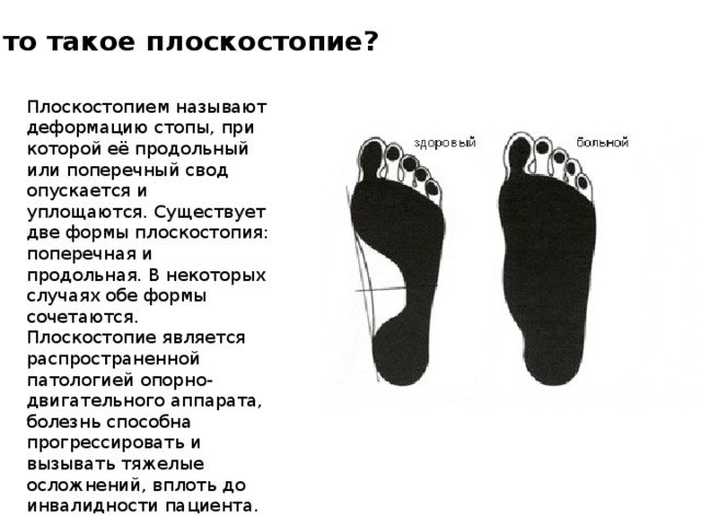 Что такое плоскостопие? Плоскостопием называют деформацию стопы, при которой её продольный или поперечный свод опускается и уплощаются. Существует две формы плоскостопия: поперечная и продольная. В некоторых случаях обе формы сочетаются. Плоскостопие является распространенной патологией опорно-двигательного аппарата, болезнь способна прогрессировать и вызывать тяжелые осложнений, вплоть до инвалидности пациента. 