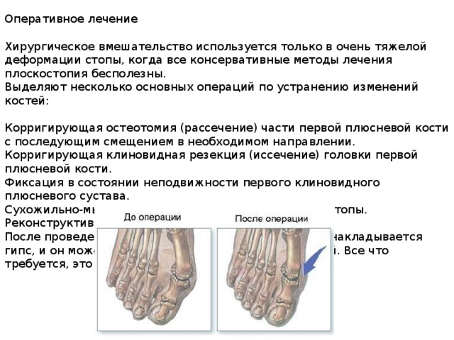 Оперативное лечение Хирургическое вмешательство используется только в очень тяжелой деформации стопы, когда все консервативные методы лечения плоскостопия бесполезны. Выделяют несколько основных операций по устранению изменений костей: Корригирующая остеотомия (рассечение) части первой плюсневой кости с последующим смещением в необходимом направлении. Корригирующая клиновидная резекция (иссечение) головки первой плюсневой кости. Фиксация в состоянии неподвижности первого клиновидного плюсневого сустава. Сухожильно-мышечная пластика поперечного свода стопы. Реконструктивная сухожильная пластика. После проведения операций на ступнях пациенту не накладывается гипс, и он может передвигаться без помощи костылей. Все что требуется, это ношение специальной обуви. 