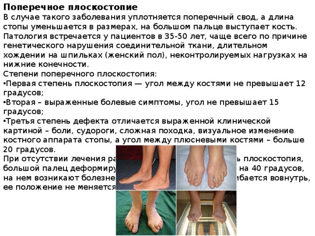 Поперечное плоскостопие В случае такого заболевания уплотняется поперечный свод, а длина стопы уменьшается в размерах, на большом пальце выступает кость. Патология встречается у пациентов в 35-50 лет, чаще всего по причине генетического нарушения соединительной ткани, длительном хождении на шпильках (женский пол), неконтролируемых нагрузках на нижние конечности. Степени поперечного плоскостопия: Первая степень плоскостопия — угол между костями не превышает 12 градусов; Вторая – выраженные болевые симптомы, угол не превышает 15 градусов; Третья степень дефекта отличается выраженной клинической картиной – боли, судороги, сложная походка, визуальное изменение костного аппарата стопы, а угол между плюсневыми костями – больше 20 градусов. При отсутствии лечения развивается четвертая степень плоскостопия, большой палец деформируется, отклоняется в сторону на 40 градусов, на нем возникают болезненные шишки, а подошва изгибается вовнутрь, ее положение не меняется во время ходьбы. 