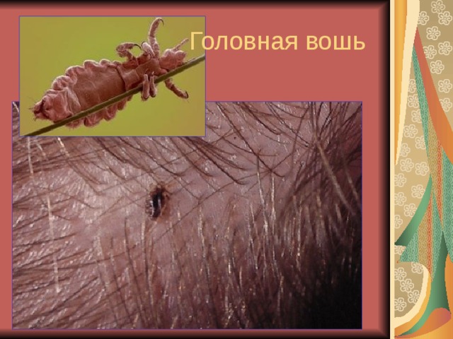 Головная вошь 