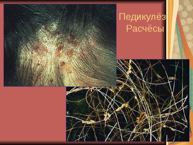 Педикулёз.  Расчёсы 