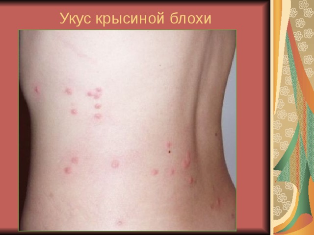 Укус крысиной блохи 