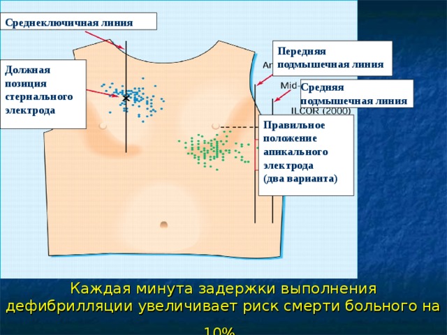 Среднеключичная линия Передняя подмышечная линия Должная позиция стернального электрода Средняя подмышечная линия Правильное положение апикального электрода (два варианта) Каждая минута задержки выполнения дефибрилляции увеличивает риск смерти больного на 10%   