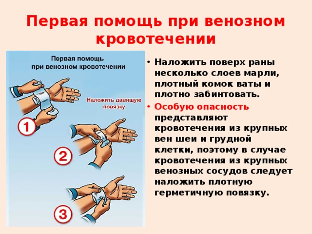 Первая помощь при венозном кровотечении Наложить поверх раны несколько слоев марли, плотный комок ваты и плотно забинтовать. Особую опасность представляют кровотечения из крупных вен шеи и грудной клетки, поэтому в случае кровотечения из крупных венозных сосудов следует наложить плотную герметичную повязку.  