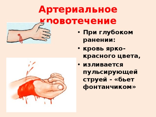 Артериальное кровотечение При глубоком ранении: кровь ярко-красного цвета, изливается пульсирующей струей - «бьет фонтанчиком»  
