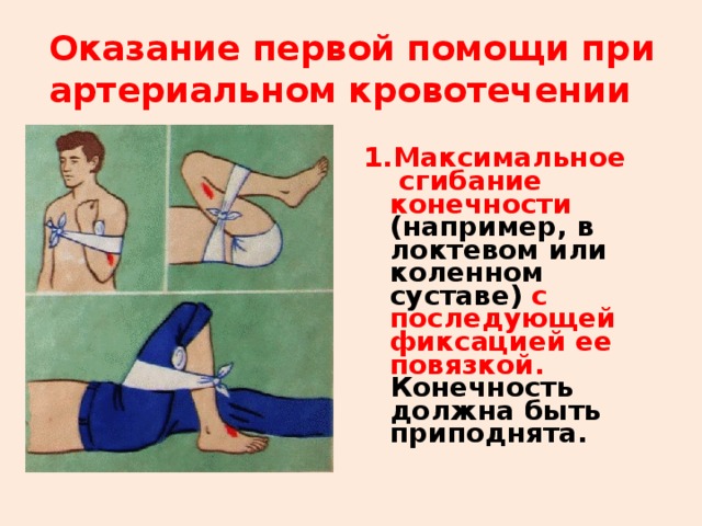 Оказание первой помощи при артериальном кровотечении Максимальное сгибание конечности (например, в локтевом или коленном суставе)  с последующей фиксацией ее повязкой. Конечность должна быть приподнята.  