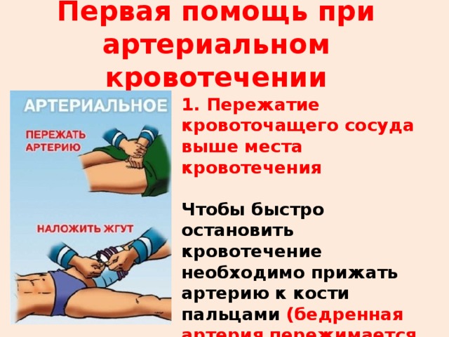 Первая помощь при артериальном кровотечении 1. Пережатие кровоточащего сосуда выше места кровотечения Чтобы быстро остановить кровотечение необходимо прижать артерию к кости пальцами (бедренная артерия пережимается кулаком!).  