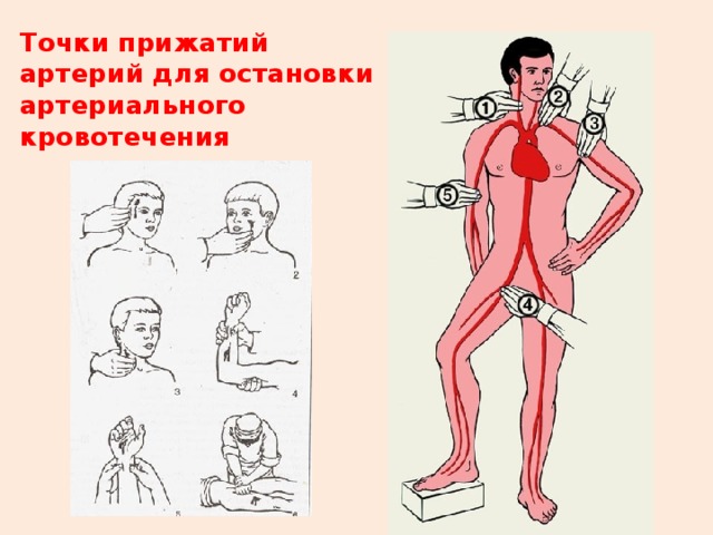 Точки прижатий артерий для остановки артериального кровотечения 