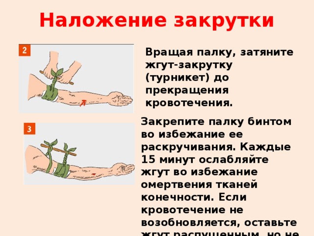 Наложение закрутки Вращая палку, затяните жгут-закрутку (турникет) до прекращения кровотечения. Закрепите палку бинтом во избежание ее раскручивания. Каждые 15 минут ослабляйте жгут во избежание омертвения тканей конечности. Если кровотечение не возобновляется, оставьте жгут распущенным, но не снимайте его на случай возникновения повторного кровотечения. 